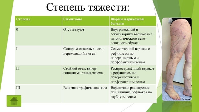 Лечение варикоза глазов